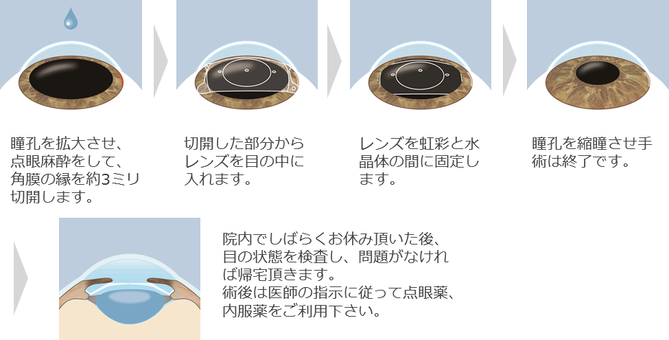 ICL手術の流れの説明図
