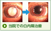 当院での白内障治療