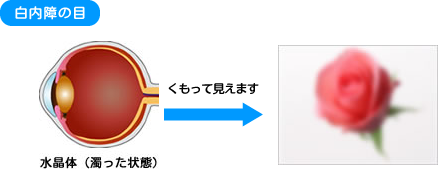 白内障で眼球の水晶体が濁っていて曇って見える状態の図
