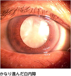かなり進んだ白内障の写真