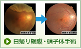 日帰り網膜・硝子体手術