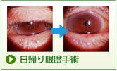 日帰り眼瞼手術