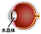 糖尿病白内障のイメージ図
