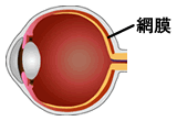 糖尿病網膜症のイメージ図