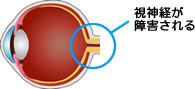 緑内障のイメージ図