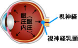 眼圧の上昇で視神経がダメージを受けるイメージ図