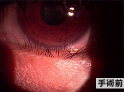 眼瞼内反の状態の写真1