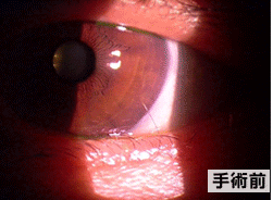 眼瞼内反の状態の写真2