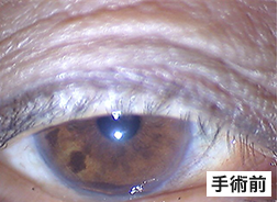 眼瞼下垂手術前のまぶたの状態の写真1