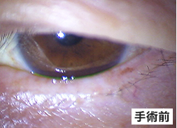 眼瞼下垂手術前のまぶたの状態の写真3