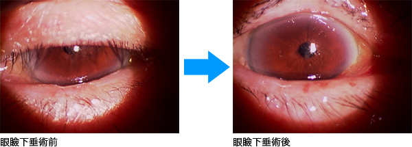 眼瞼下垂手術前後画像